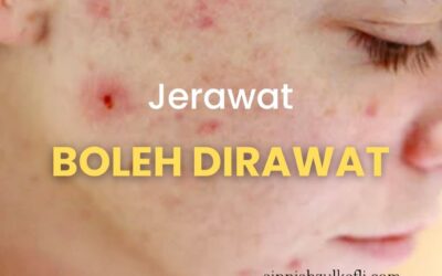 Jerawat Tak Pernah Berkesudahan? Ini 4 Punca Jerawat di Muka